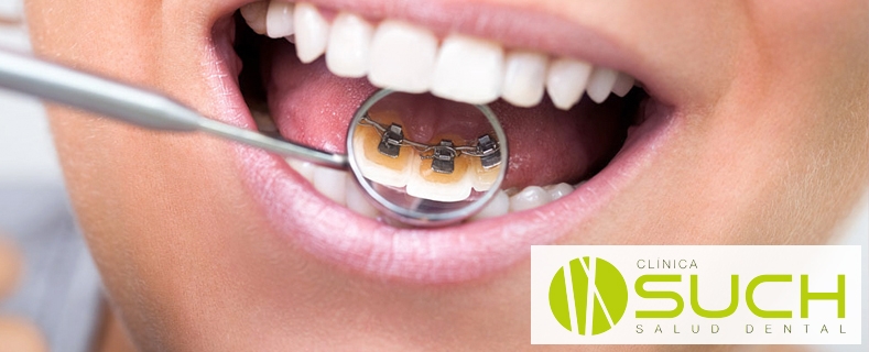 Ortodoncia lingual: una solución invisible para tus dientes