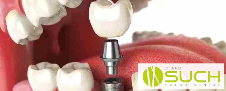 Implantes dentales: ¿Cómo son en su interior?