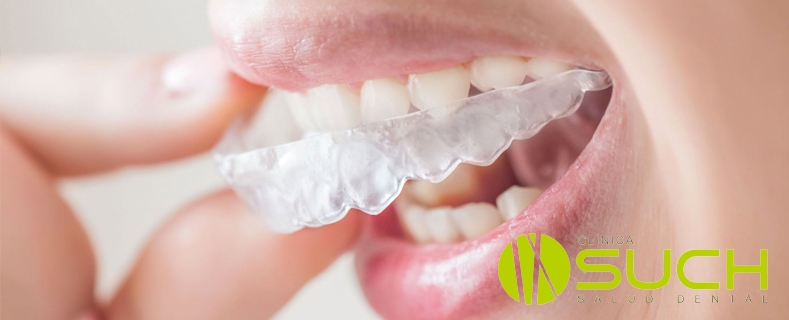 Apiñamiento dental: ¿qué es y por qué ocurre?