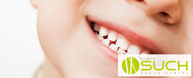 Los dientes de leche: ¿Es aconsejable forzar la caída de los dientes de leche?