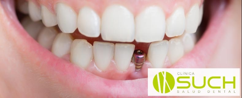 ¿Cómo evitar el rechazo de un implante dental?
