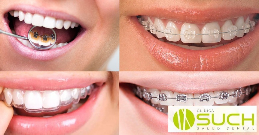 ¿Que es la ortodoncia y como puede ayudarnos? (Parte 1)