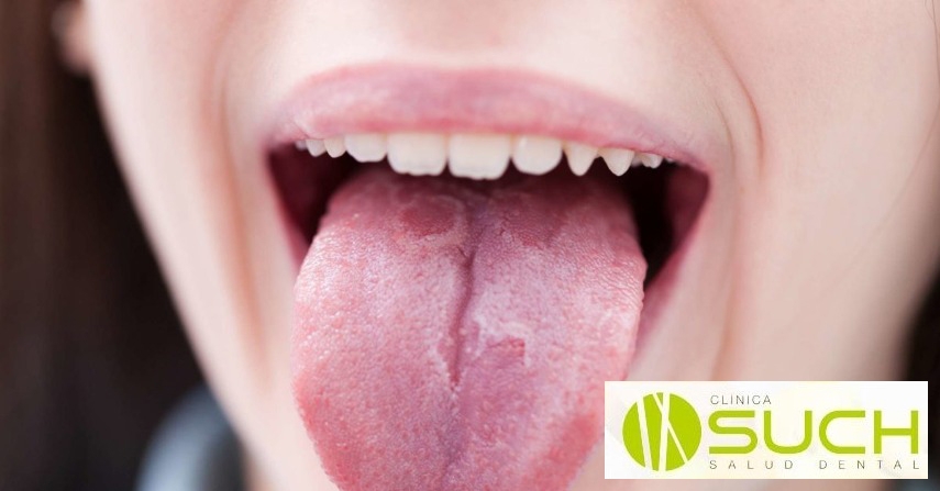 ¿Que es la psoriasis oral?