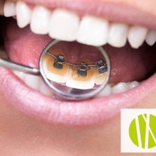 Ortodoncia lingual: una solución invisible para tus dientes