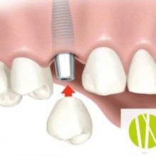 Implantología: ¿Qué hacer cuando nos falta un único diente?