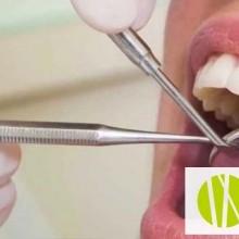 Los empastes dentales: ¿Puedo volver a tener caries en un diente empastado?